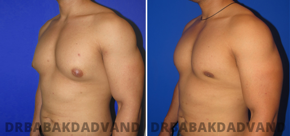  Before and After Photos. Gynecomastia. 3